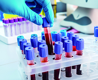 Circulating Tumor DNA Screening finds the true murder of cancer